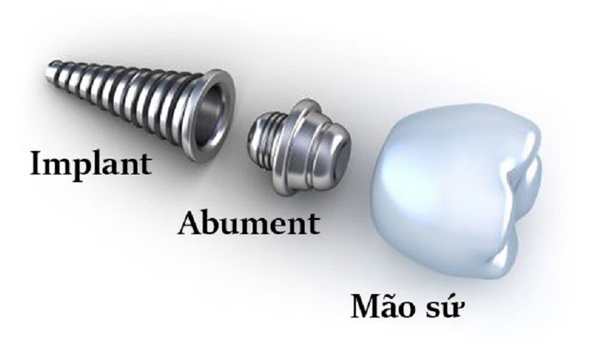 Chi phí trồng răng Implant Hàn Quốc phụ thuộc vào giá của các thành phần cấu tạo