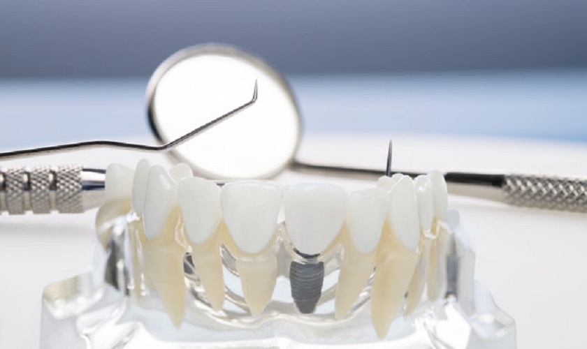 Trồng răng Implant mất bao lâu thời gian?