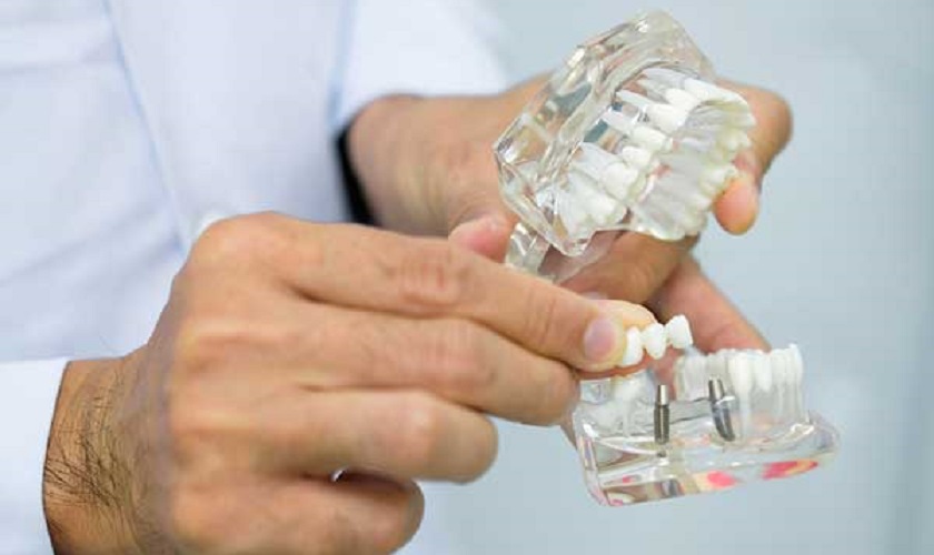 Trồng răng Implant Mỹ và những điều cần biết