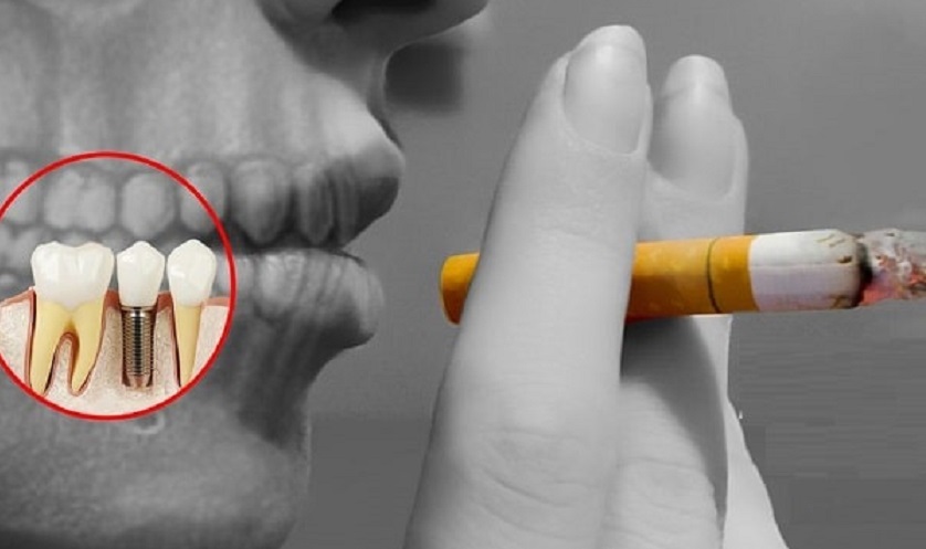 Không hút thuốc lá trước và sau khi trồng răng Implant tối thiểu 2 tuần