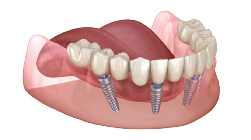 Trụ Implant cần được đặt đúng hướng để đảm bảo độ bền chắc lâu dài