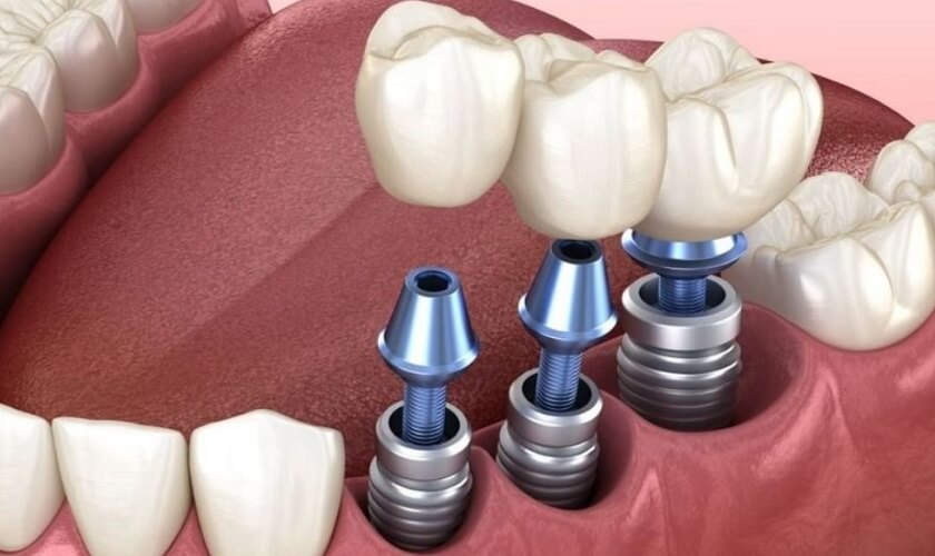 Bảng giá cấy ghép Implant và những yếu tố ảnh hưởng