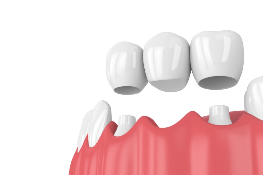 Phương pháp cầu răng sứ phục hình răng cửa