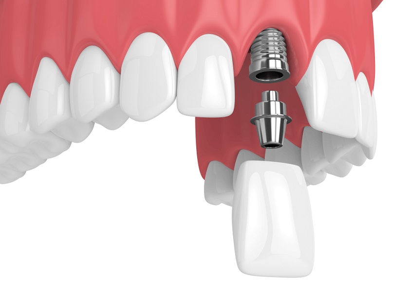 Phục hình răng cửa bằng cấy ghép Implant