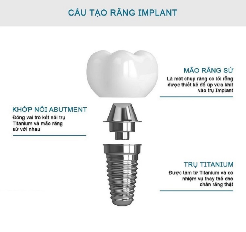 Cấu tạo răng implant hoàn chỉnh