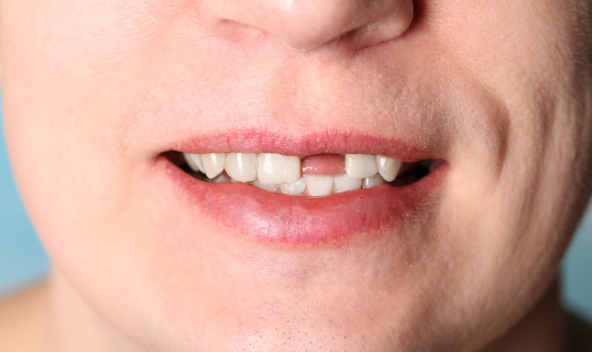 Đối tượng cấy ghép implant Đối tượng cấy ghép implant