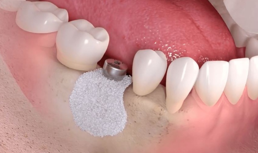 Ghép xương để cấy ghép implant Ghép xương để cấy ghép implant