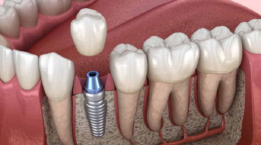 Trồng răng Implant không gây xâm lấn đến các răng thật bên cạnh Trồng răng Implant không gây xâm lấn đến các răng thật bên cạnh