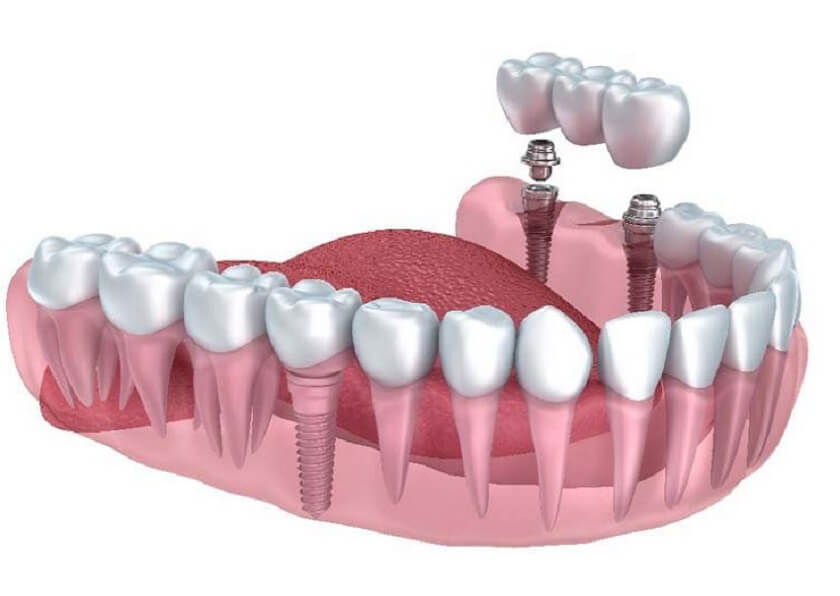 Trồng răng Implant có nhược điểm gì? Trồng răng Implant có nhược điểm gì?