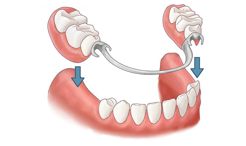 Hàm giả tháo lắp