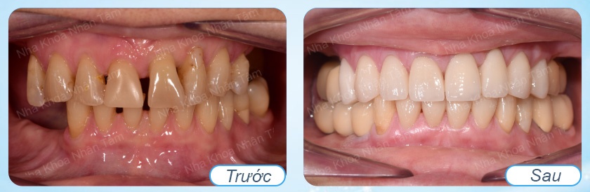 Hình trước và sau trồng răng implant đơn lẻ Hình trước và sau trồng răng implant đơn lẻ