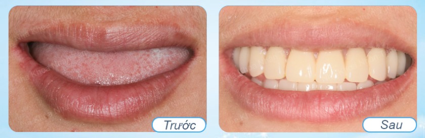 Hình trước và sau trồng răng implant toàn hàm Hình trước và sau trồng răng implant toàn hàm