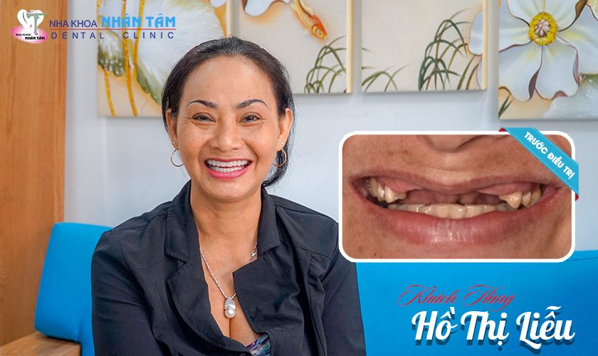 Khách hàng Hồ Thị Liễu trồng implant Khách hàng Hồ Thị Liễu trồng implant