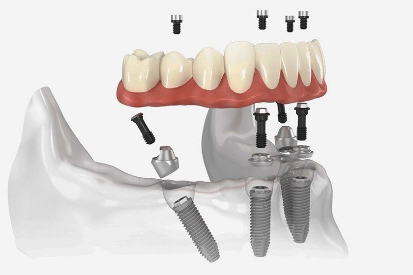 Nên tìm hiểu thông tin tổng quát trước khi cấy ghép Implant