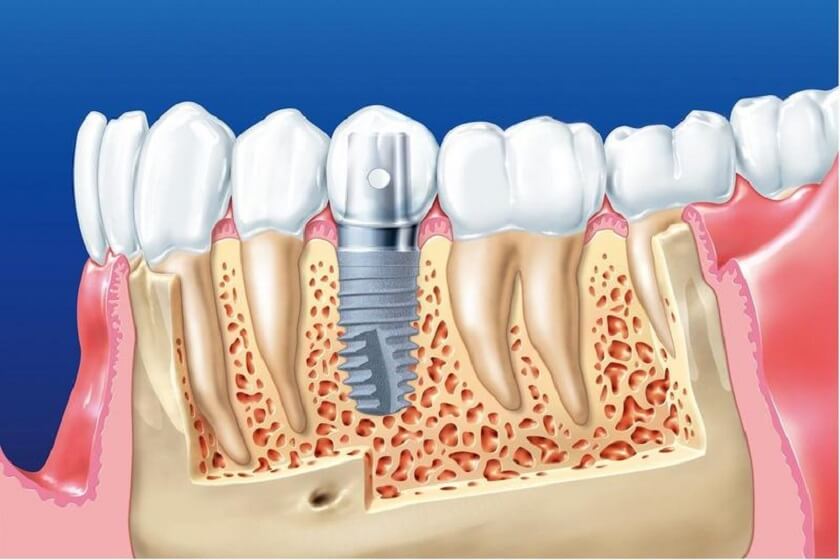 Phương pháp trồng răng Implant Phương pháp trồng răng Implant