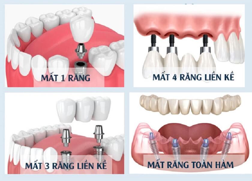 Các trường hợp nên áp dụng kỹ thuật trồng răng Implant Các trường hợp nên áp dụng kỹ thuật trồng răng Implant