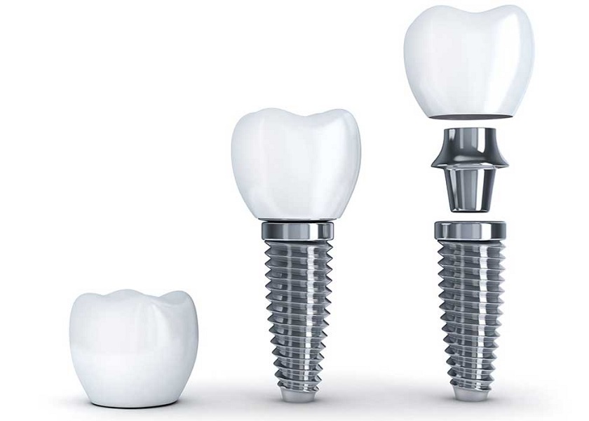Răng implant