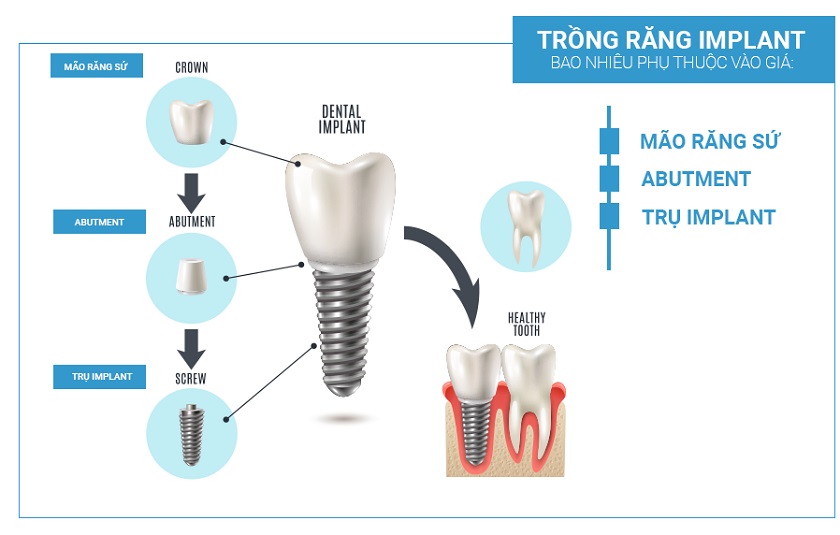 Chi phí trồng răng Implant