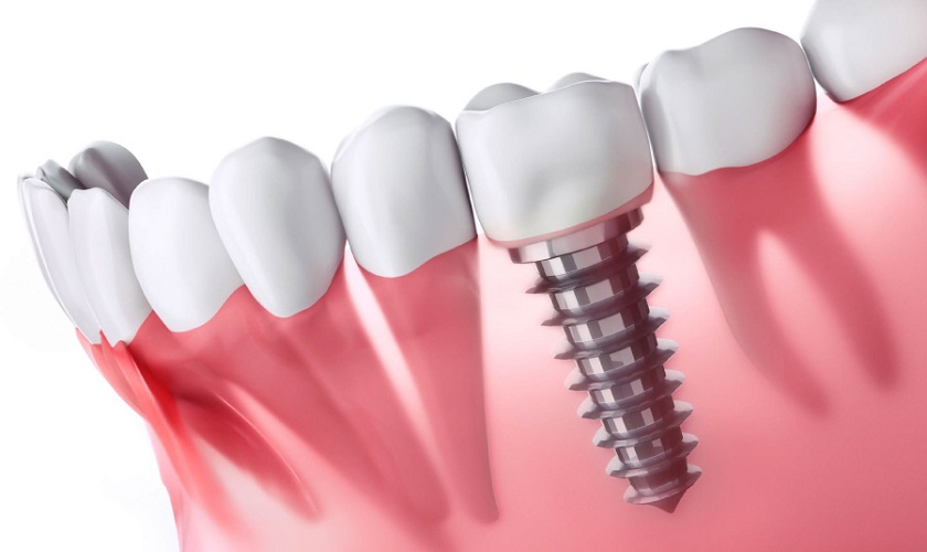 Răng Implant là gì? Chi phí trồng răng Implant