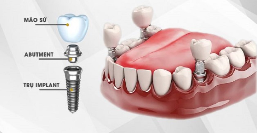 Cấy ghép Implant trong nha khoa