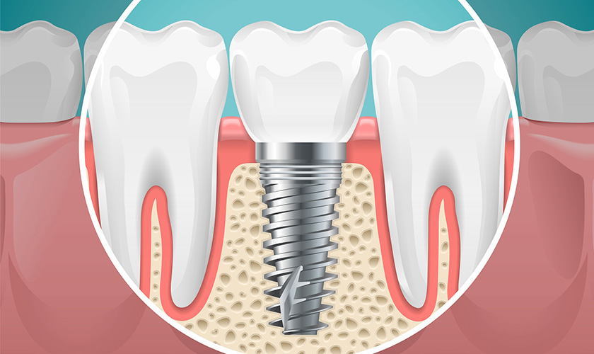 Trồng Implant và những lưu ý khi tiến hành