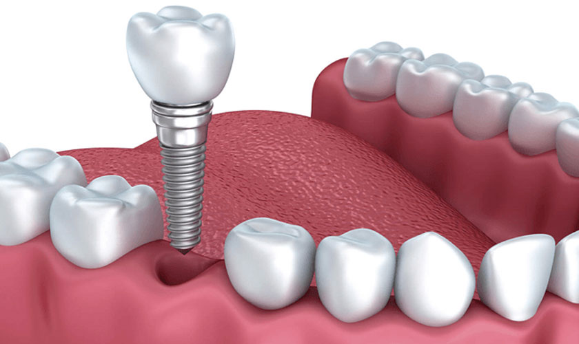 Cấy ghép Implant