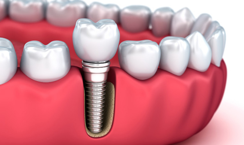 Trồng răng Implant có nguy hiểm không?