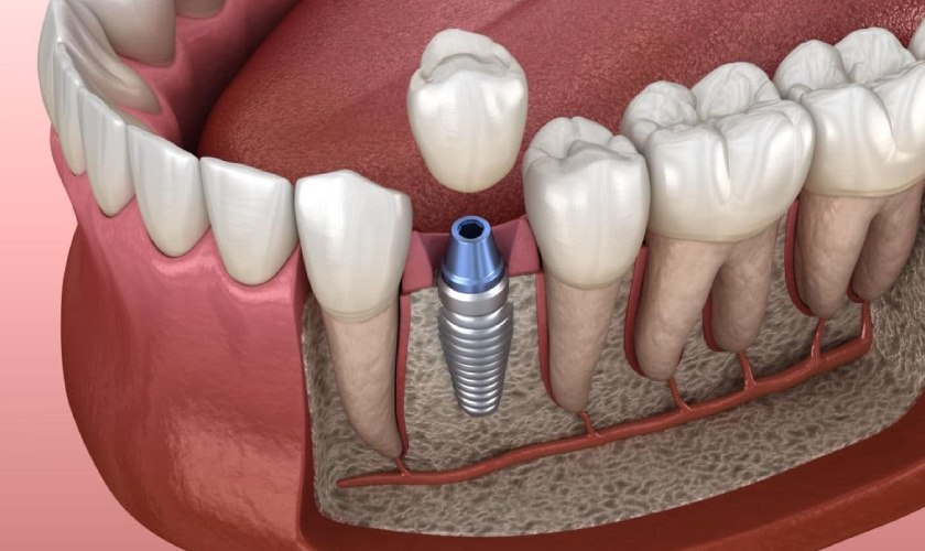 Trồng răng implant - Phương pháp khôi phục răng mất hoàn hảo nhất