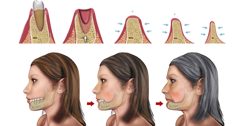 Mức độ phức tạp của ca cấy ghép có ảnh hưởng tới chi phí dịch vụ