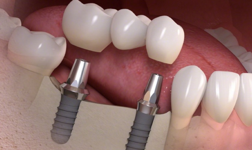 Răng Implant mang lại thẩm mỹ cao