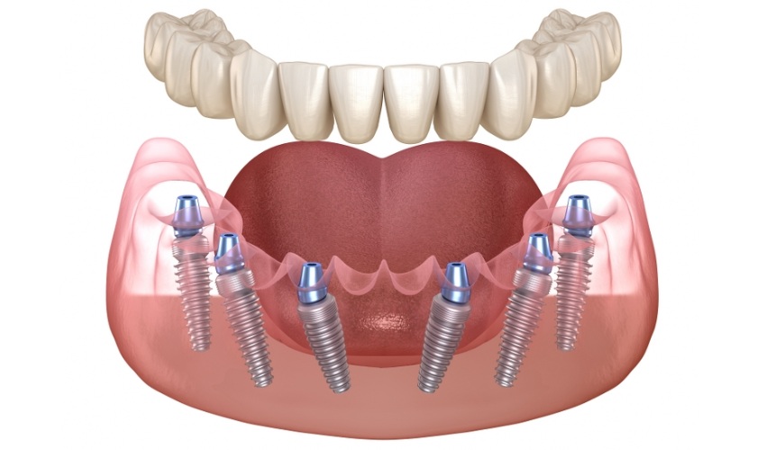Trồng răng Implant ở TP.HCM