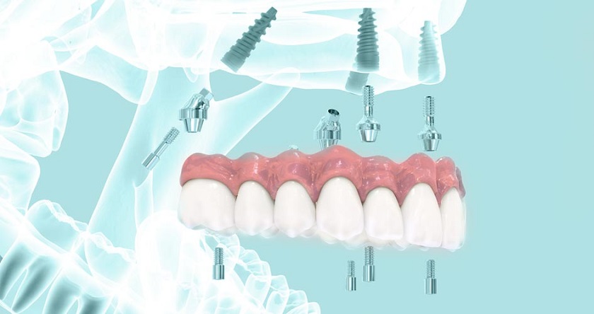 Có nên trồng răng Implant trả góp không?