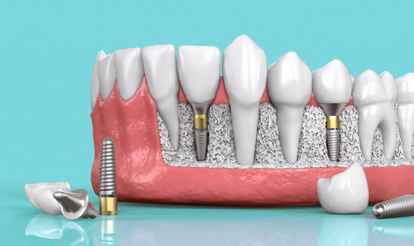 Trồng răng Implant trả góp – lợi ích và điều kiện