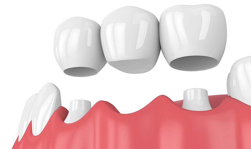 Cầu răng sứ cũng là một kỹ thuật làm răng khểnh được nhiều khách hàng lựa chọn