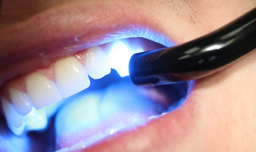 Trồng răng khểnh bằng đắp composite (trám răng)