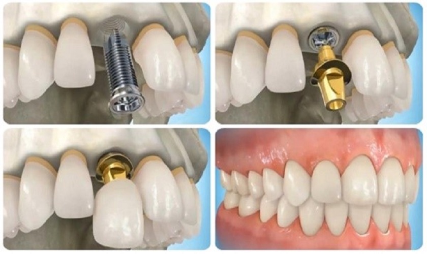 Làm răng nanh bằng cấy ghép Implant