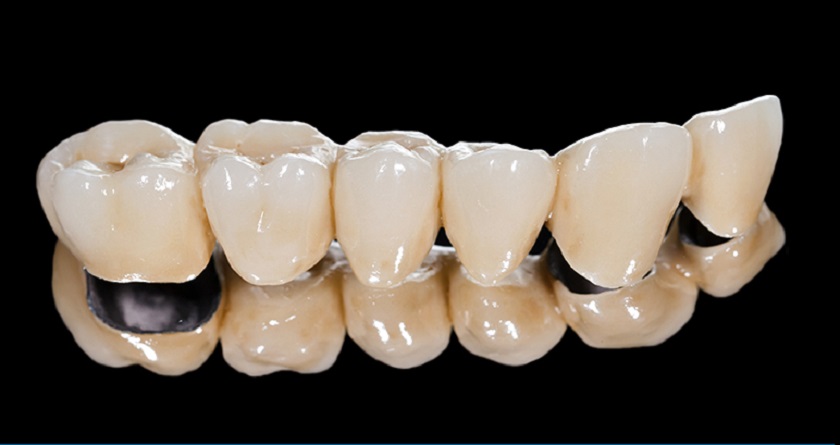 Có nên trồng răng sứ Titan không?