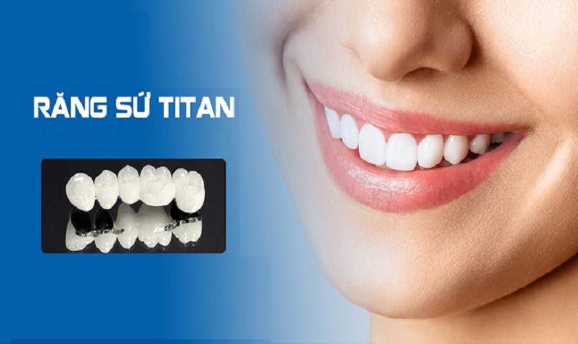 Trồng răng sứ Titan và các thông tin quan trọng cần nắm rõ