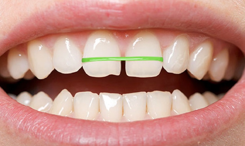 Chỉnh nha bằng dây chun