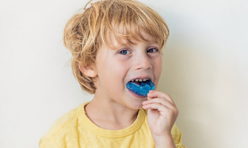 Niềng răng bằng máng nhựa sản xuất hàng loạt