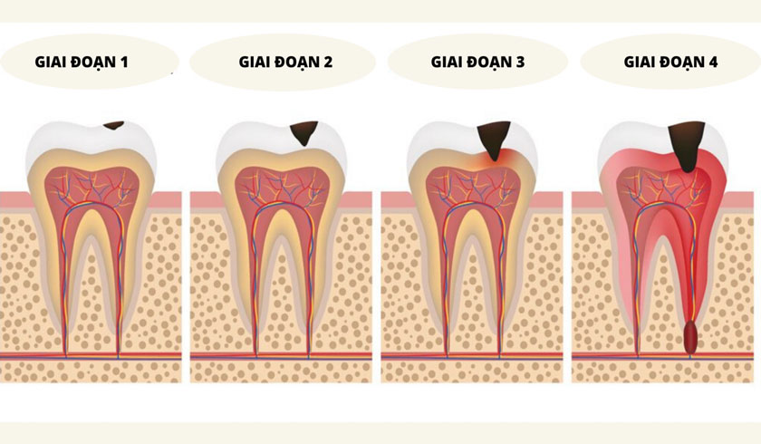 Biến chứng khôn lường của viêm tủy răng Biến chứng khôn lường của viêm tủy răng