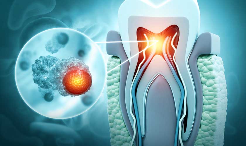 Viêm tủy răng gây ra nhiều biến chứng nguy hiểm