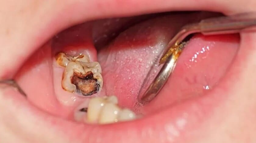 Viêm tủy răng số 7 là căn bệnh ảnh hưởng xấu đến sức khỏe răng miệng