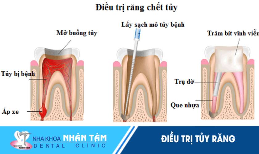 Điều trị tủy răng để tránh những biến chứng nguy hiểm