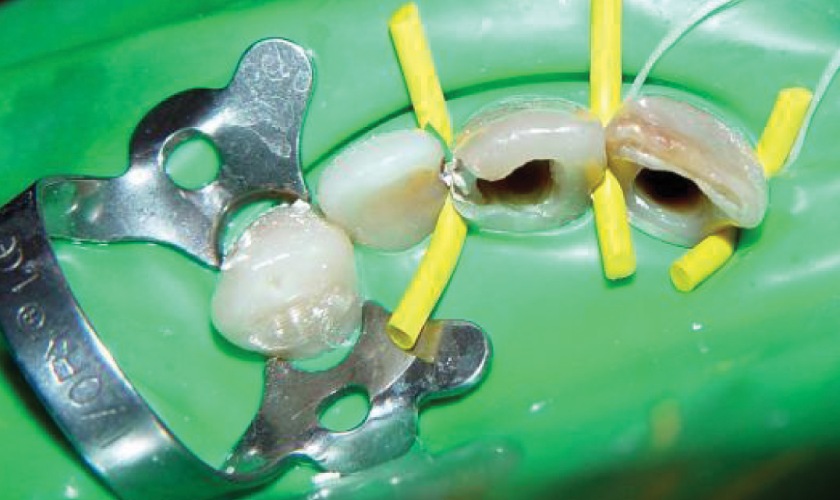 Điều trị tủy răng để tránh các biến chứng nguy hiểm.