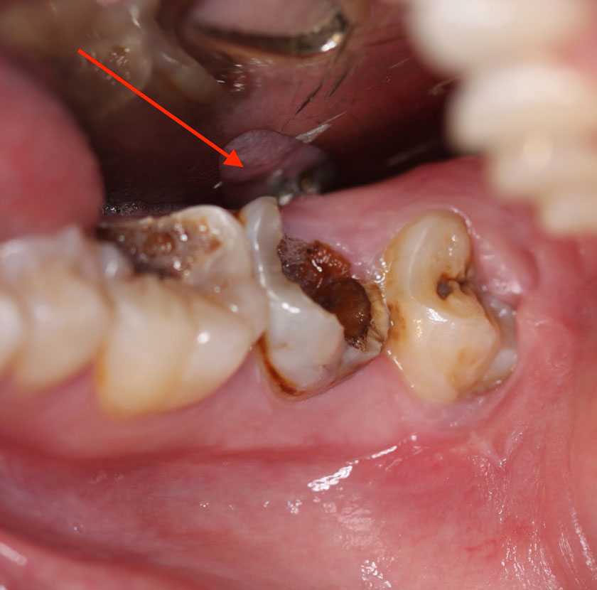 3. Triệu Chứng Nhiễm Trùng Tủy Răng