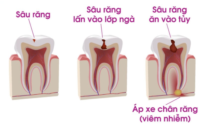 Sâu răng lâu ngày sẽ dẫn đến viêm tủy răng