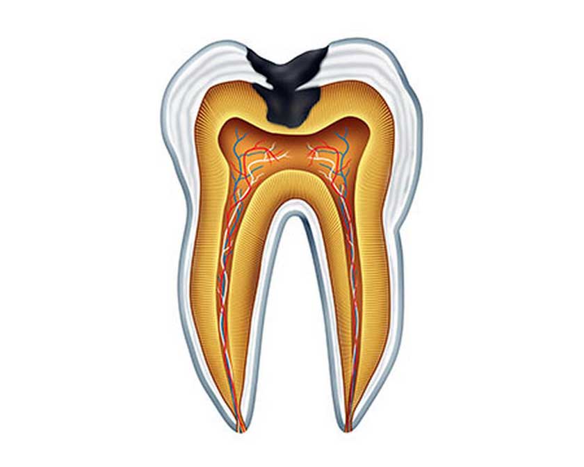 Viêm tủy răng bao gồm viêm tủy có hồi phục và viêm tủy không hồi phục