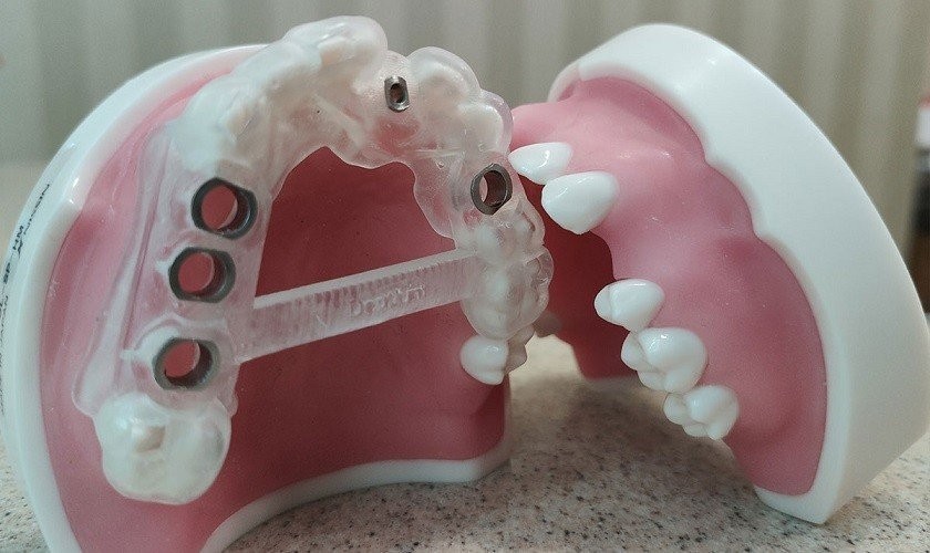 Máng hướng dẫn hỗ trợ bác sĩ trong việc phục hình răng Implant hiệu quả