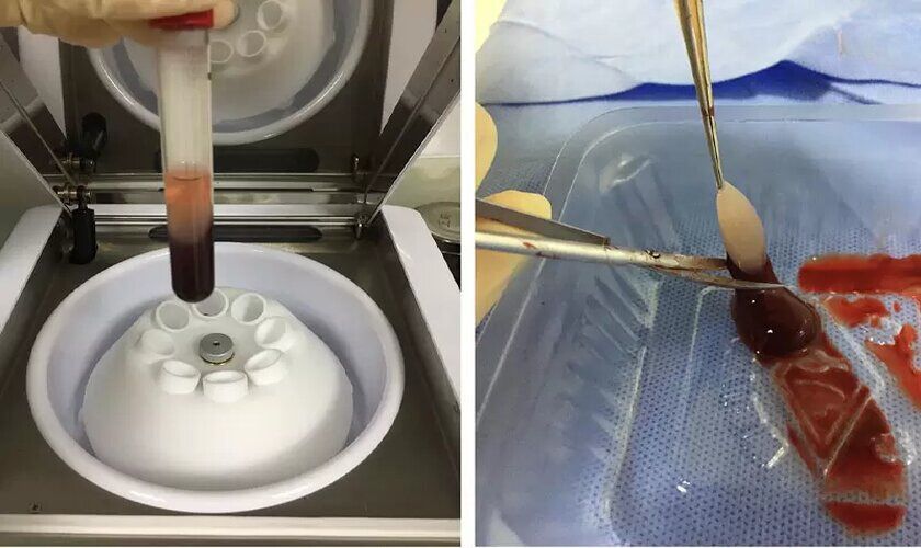 Ứng dụng PRF giúp nâng cao khả năng lành thương sau khi cấy ghép Implant